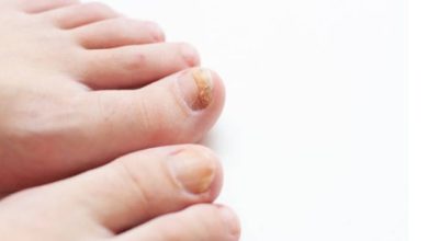 How to Removed Ingrown Toenail Safely