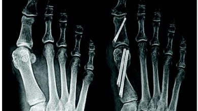 Where to Get Minimally Invasive Bunion Surgery in AZ