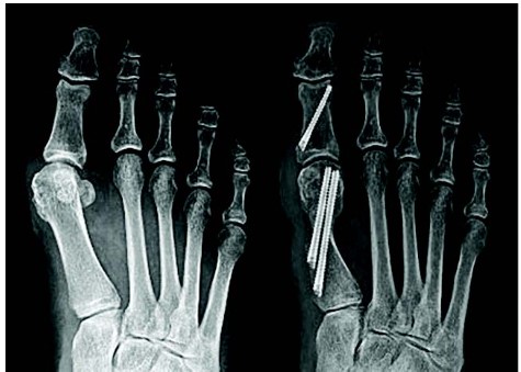 Where to Get Minimally Invasive Bunion Surgery in AZ