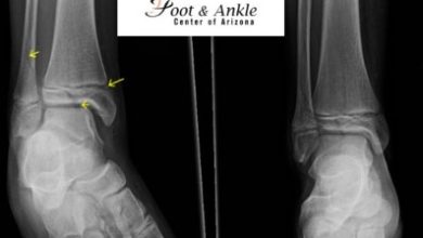 Where to Find Ankle ORIF CPT Code Info
