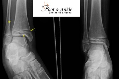 Where to Find Ankle ORIF CPT Code Info