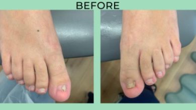 Who is the Best Toenail Removal Surgery in Scottsdale