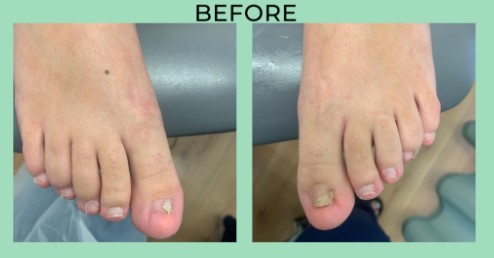 Who is the Best Toenail Removal Surgery in Scottsdale