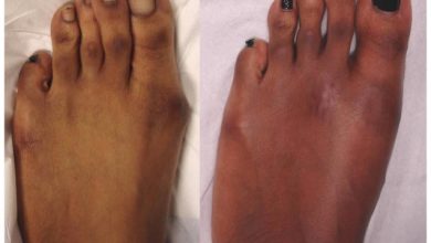 What Are the Different Types of Bunion Surgery Exploring Your Options