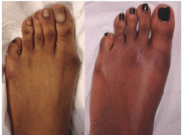 What Are the Different Types of Bunion Surgery Exploring Your Options