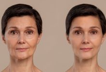 What Can I Expect Immediately After Botox Injections